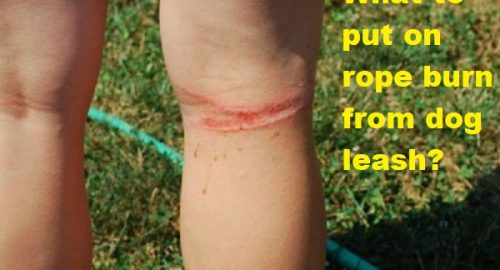 What to put on rope burn from dog leash